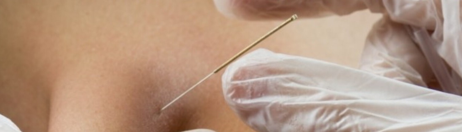 Dry needling behandeling bij Fysiopark - Fysiopark